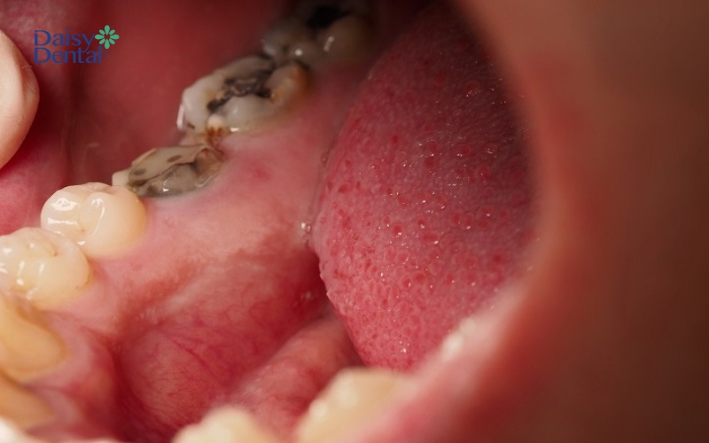 17 tuổi nhổ răng có mọc lại không? Mất răng cần làm gì?