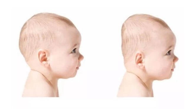 Các cách chữa méo đầu cho trẻ 3 tháng tuổi hiệu quả
